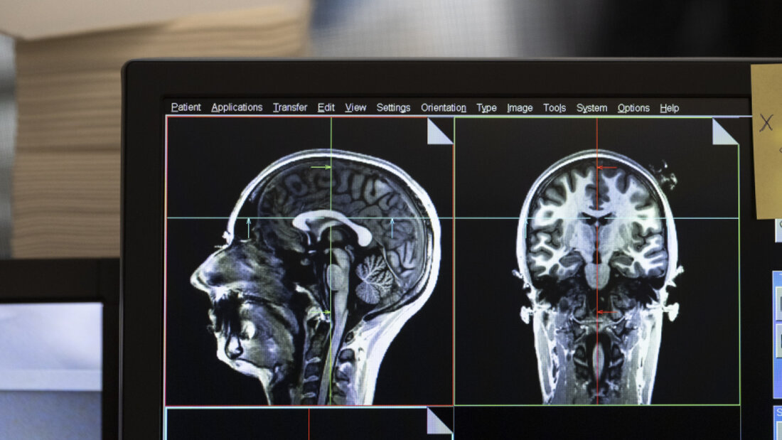 Mit einem Magnetresonanztomographen (MRT) lassen sich in Gehirnen von Schmerzpatienten Veränderungen nachweisen. (Symbolbild) 20260827080025208.jpg